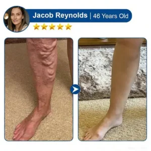 🇺🇸👨‍⚕️✅TAILEDEN® 𝑽𝗲𝗶𝙣 𝘾𝐨𝐧𝘁𝗼𝙪𝙧 𝙈𝙞𝐜𝐫𝒐𝒏𝒆𝗲𝗱𝗹𝙚 𝙋𝙖𝐭𝐜𝒉 𝒘𝒊𝘁𝗵 𝗔𝙙𝙫𝙖𝙣𝙘𝐞𝐝 𝐃𝒊𝒐𝒔𝗺𝙞𝐧 & 𝑯𝒆𝘀𝗽𝗲𝙧𝙞𝙙𝙞𝐧 𝐃𝒆𝒍𝒊𝒗𝗲𝗿𝙮🌿𝟕-𝐃𝐚𝐲 𝐕𝐢𝐬𝐢𝐛𝐥𝐞 𝐑𝐞𝐬𝐮𝐥𝐭𝐬 𝐟𝐨𝐫 𝐕𝐚𝐫𝐢𝐜𝐨𝐬𝐞 𝐕𝐞𝐢𝐧𝐬