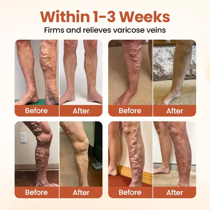 🚨TAILEDEN™ VeinTarget Microneedle Patch🚨Painless Varicose Vein Treatment at Home 🌿 — 60% MAX OFF! ⏳ Limited Time Offer!