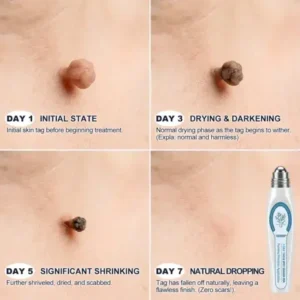 TAILEDEN® 7-Day Skin Tag & Spot Eraser Painless & Scar-Free Advanced Imperfection Removal Rollerball Pen