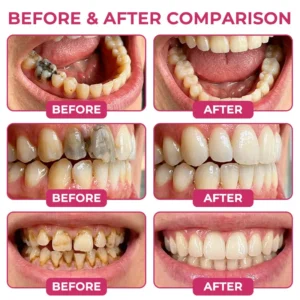 TAILEDEN® Cavity-Repair Natural Enamel Filling Gel