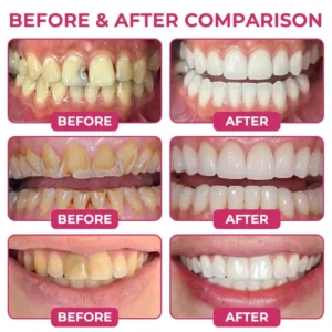 TAILEDEN® Cavity-Repair Natural Enamel Filling Gel